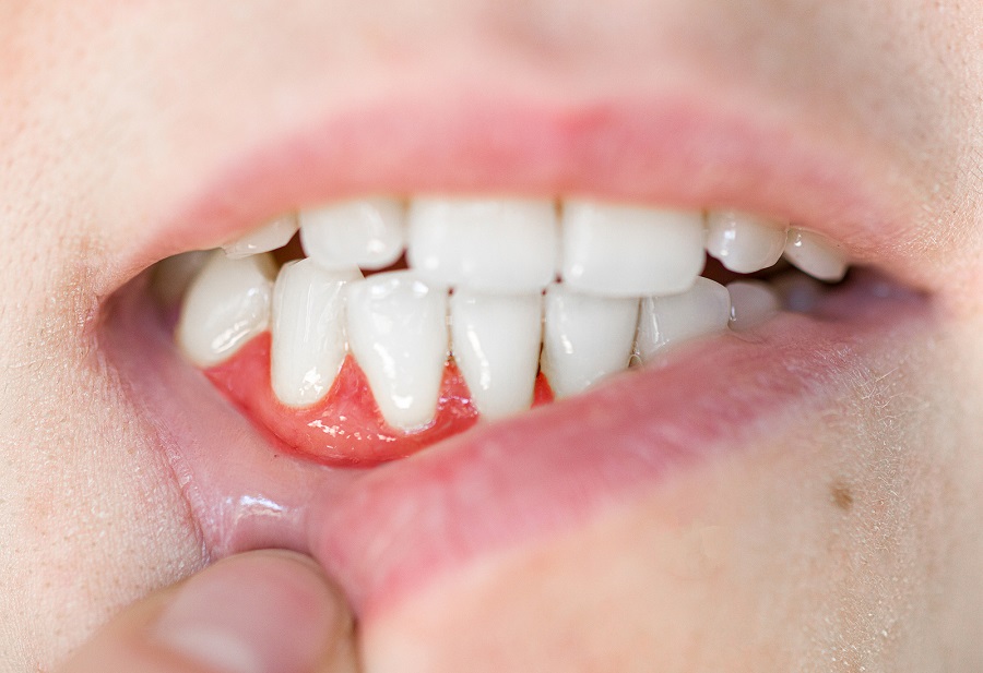 Diabetes and Gum Disease Risk
