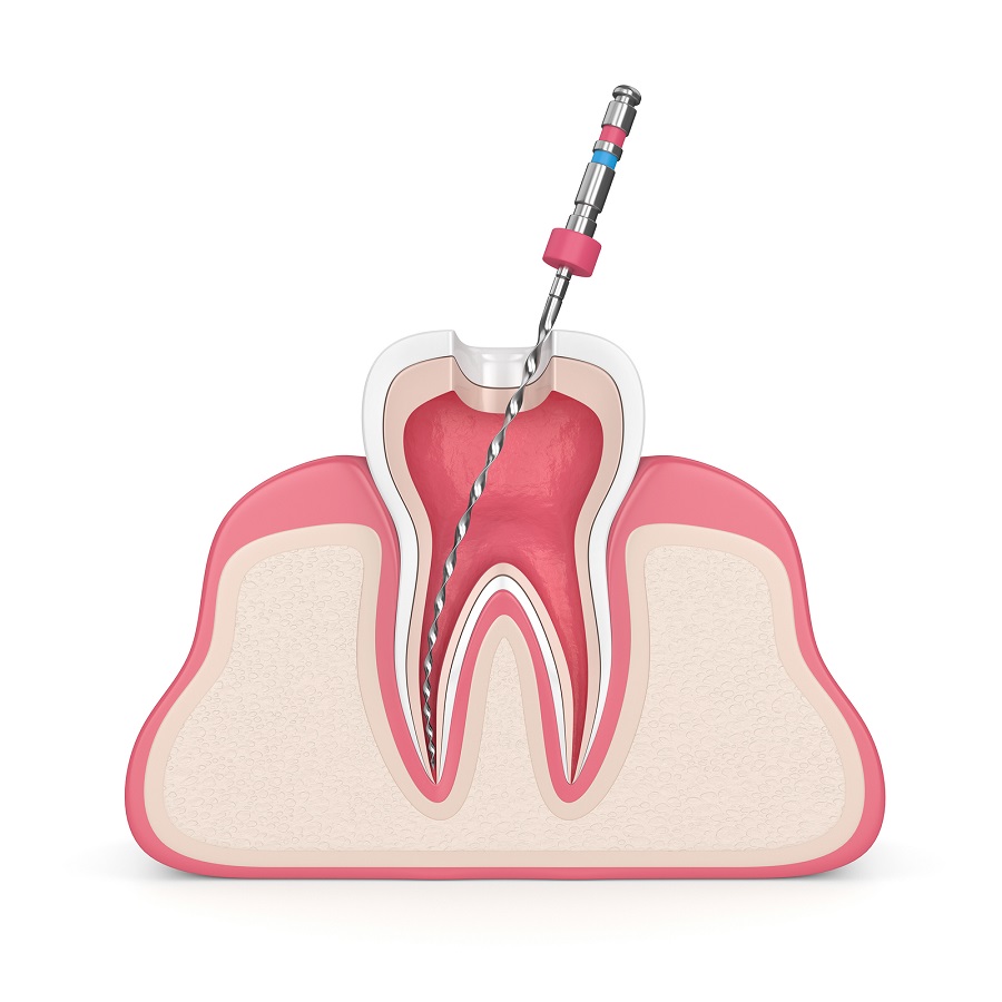 How to Know If You Need a Root Canal Therapy?