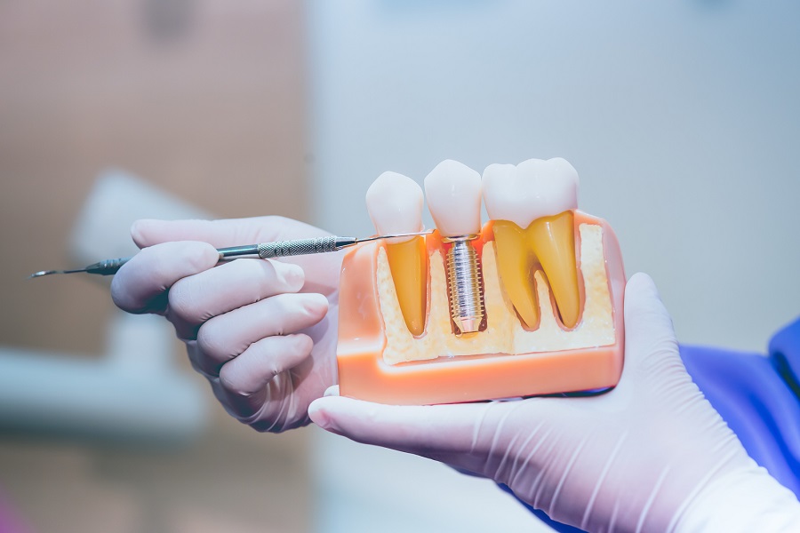 The Various Types of Dental Implants to Choose From