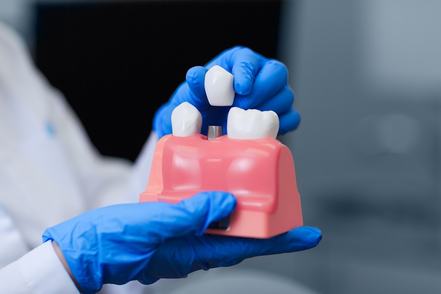 Why Are Dental Implants Important?