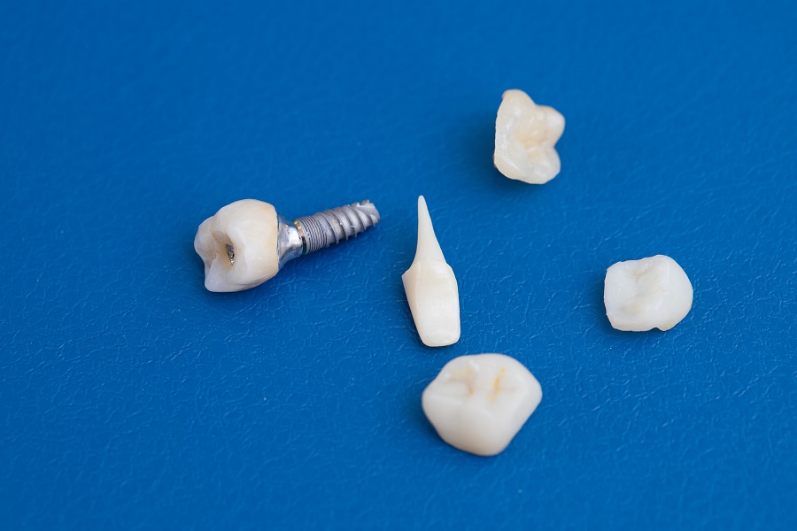 The Benefits of In-house Restorations and Placement